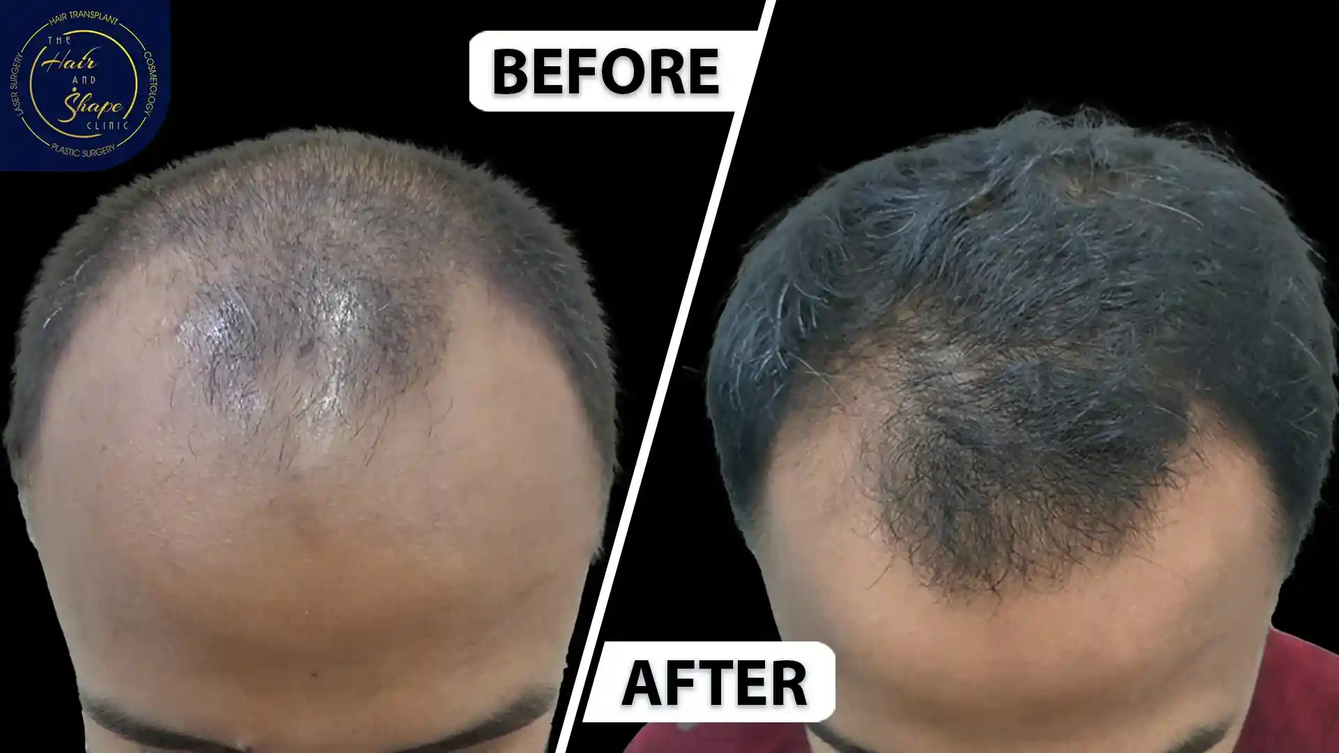 PRP Treatment result9